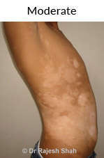 Moderate Vitiligo Treatment