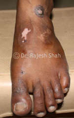 Vitiligo on Foot