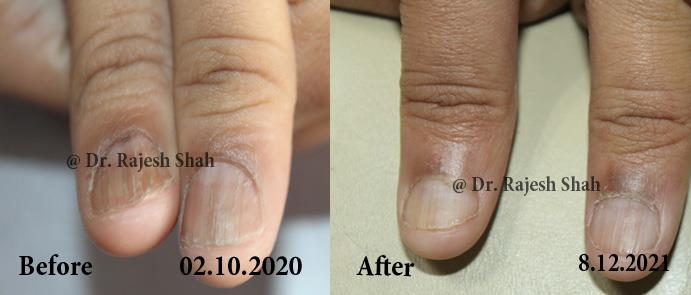 before after of lichen planus on nails