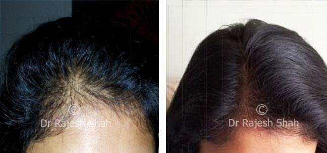 Homeopathic Treatment and Medicine for Hair Fall/Hair Loss | Highly  Effective Treatment