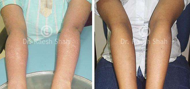 Eczema in Hindi: Treatment, Causes, Symptoms for Atopic Dermatitis in Hindi