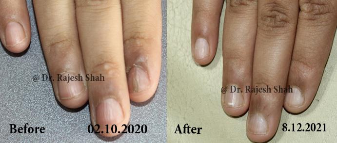 before after of lichen planus on nails