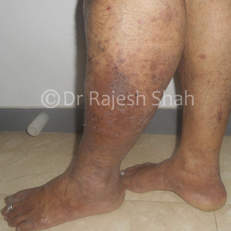 Lichen planus spots on legs