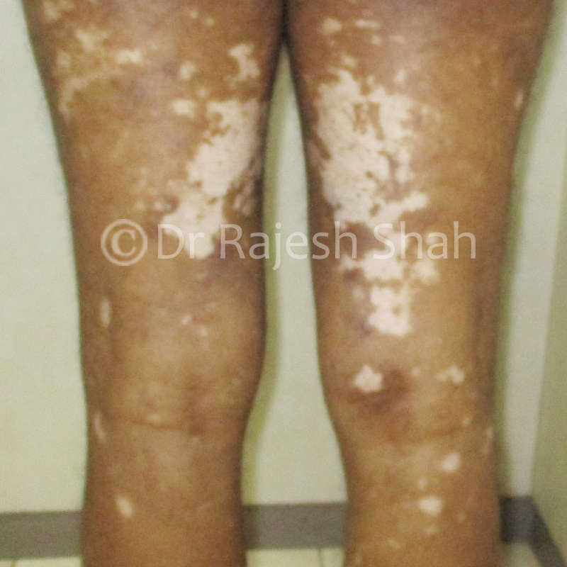 Vitiligo spots