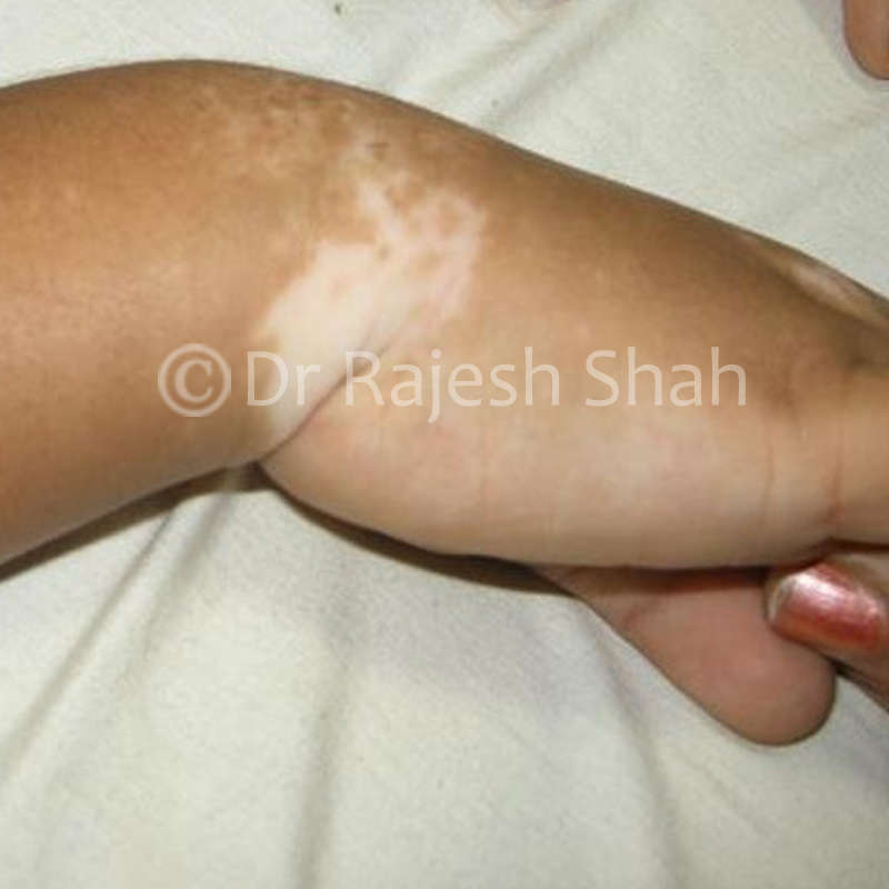 Vitiligo spots 